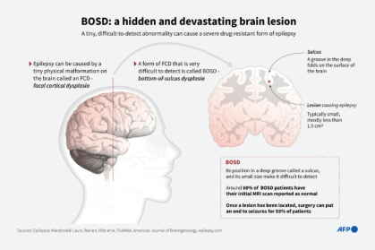 Infographic explainer of BOSD, a difficult-to-detect form of an epilepsy-causing brain malformation - John SAEKI, Laurence CHU, Nicholas SHEARMAN (AFP)